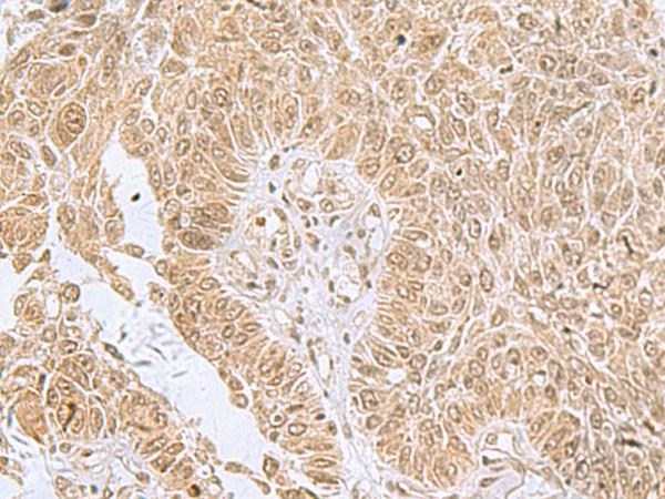 PHF6 Antibody - Immunohistochemistry of paraffin-embedded Human lung cancer tissue  using PHF6 Polyclonal Antibody at dilution of 1:85(×200)