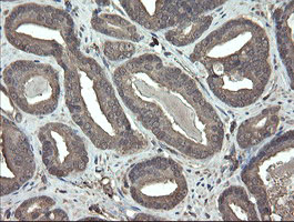 PHF7 Antibody - IHC of paraffin-embedded Carcinoma of Human prostate tissue using anti-PHF7 mouse monoclonal antibody.