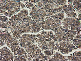 PHF7 Antibody - IHC of paraffin-embedded Carcinoma of Human liver tissue using anti-PHF7 mouse monoclonal antibody.