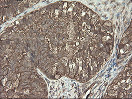 PHF7 Antibody - IHC of paraffin-embedded Adenocarcinoma of Human ovary tissue using anti-PHF7 mouse monoclonal antibody.