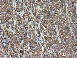 PHF7 Antibody - IHC of paraffin-embedded Carcinoma of Human thyroid tissue using anti-PHF7 mouse monoclonal antibody.