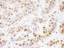 PHF8 Antibody - Detection of Human PHF8 by Immunohistochemistry. Sample: FFPE section of human breast carcinoma. Antibody: Affinity purified rabbit anti-PHF8 used at a dilution of 1:100.
