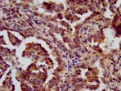 PHF9 / FANCL Antibody - IHC image of FANCL Antibody diluted at 1:600 and staining in paraffin-embedded human lung cancer performed on a Leica BondTM system. After dewaxing and hydration, antigen retrieval was mediated by high pressure in a citrate buffer (pH 6.0). Section was blocked with 10% normal goat serum 30min at RT. Then primary antibody (1% BSA) was incubated at 4°C overnight. The primary is detected by a biotinylated secondary antibody and visualized using an HRP conjugated SP system.