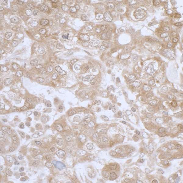 PHGDH Antibody - Detection of human PHGDH by immunohistochemistry. Sample: FFPE section of human breast carcinoma. Antibody: Affinity purified rabbit anti- PHGDH used at a dilution of 1:1,000 (1µg/ml). Detection: DAB