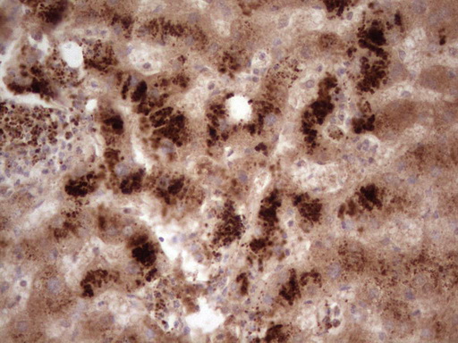PHGDH Antibody - Immunohistochemical staining of paraffin-embedded Human liver tissue within the normal limits using anti-PHGDH mouse monoclonal antibody. (Heat-induced epitope retrieval by 1 mM EDTA in 10mM Tris, pH8.5, 120C for 3min,