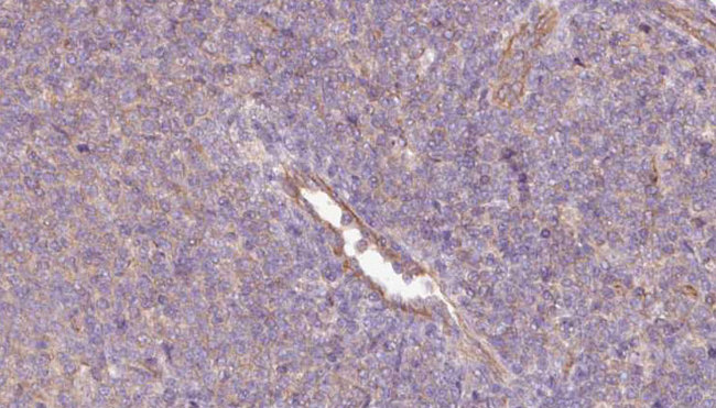 PHGDH Antibody - 1:100 staining human lymph carcinoma tissue by IHC-P. The sample was formaldehyde fixed and a heat mediated antigen retrieval step in citrate buffer was performed. The sample was then blocked and incubated with the antibody for 1.5 hours at 22°C. An HRP conjugated goat anti-rabbit antibody was used as the secondary.