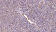 PHGDH Antibody - 1:100 staining human lymph carcinoma tissue by IHC-P. The sample was formaldehyde fixed and a heat mediated antigen retrieval step in citrate buffer was performed. The sample was then blocked and incubated with the antibody for 1.5 hours at 22°C. An HRP conjugated goat anti-rabbit antibody was used as the secondary.