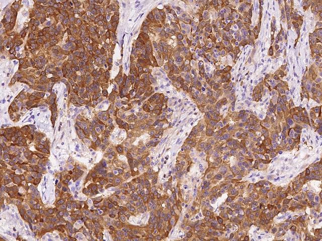 PHGDH Antibody - Immunochemical staining of human PHGDH in human breast carcinoma with rabbit polyclonal antibody at 1:100 dilution, formalin-fixed paraffin embedded sections.