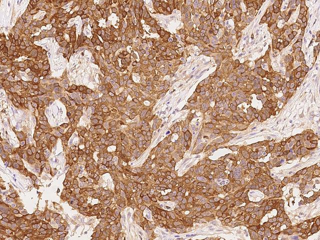 PHGDH Antibody - Immunochemical staining of human PHGDH in human breast carcinoma with rabbit polyclonal antibody at 1:200 dilution, formalin-fixed paraffin embedded sections.