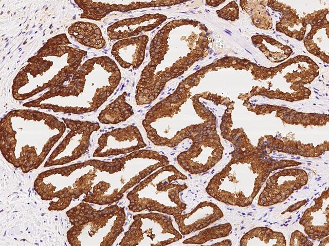 PHGDH Antibody - Immunochemical staining of human PHGDH in human prostate with rabbit polyclonal antibody at 1:200 dilution, formalin-fixed paraffin embedded sections.