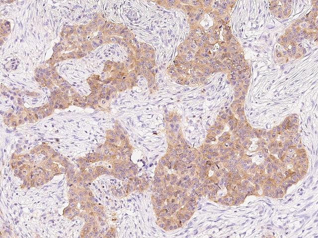 PHGDH Antibody - Immunochemical staining of human PHGDH in human breast carcinoma with rabbit polyclonal antibody at 1:1000 dilution, formalin-fixed paraffin embedded sections.