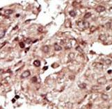 PHKG1 Antibody - Formalin-fixed and paraffin-embedded human cancer tissue reacted with the primary antibody, which was peroxidase-conjugated to the secondary antibody, followed by AEC staining. This data demonstrates the use of this antibody for immunohistochemistry; clinical relevance has not been evaluated. BC = breast carcinoma; HC = hepatocarcinoma.