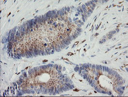 PHKG2 Antibody - IHC of paraffin-embedded Adenocarcinoma of Human colon tissue using anti-PHKG2 mouse monoclonal antibody. (Heat-induced epitope retrieval by 10mM citric buffer, pH6.0, 100C for 10min).