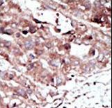 PHKG2 Antibody - Formalin-fixed and paraffin-embedded human cancer tissue reacted with the primary antibody, which was peroxidase-conjugated to the secondary antibody, followed by AEC staining. This data demonstrates the use of this antibody for immunohistochemistry; clinical relevance has not been evaluated. BC = breast carcinoma; HC = hepatocarcinoma.