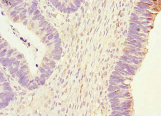 PHKG2 Antibody - Immunohistochemistry of paraffin-embedded human ovarian cancer at dilution 1:100