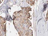 PHLDA2 / TSSC3 Antibody - 1:100 staining human breast carcinoma tissue by IHC-P. The tissue was formaldehyde fixed and a heat mediated antigen retrieval step in citrate buffer was performed. The tissue was then blocked and incubated with the antibody for 1.5 hours at 22°C. An HRP conjugated goat anti-rabbit antibody was used as the secondary.