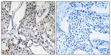 PHLDA3 Antibody - Immunohistochemistry analysis of paraffin-embedded human breast carcinoma tissue, using PHLDA3 Antibody. The picture on the right is blocked with the synthesized peptide.