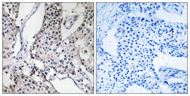 PHLDA3 Antibody - Peptide - + Immunohistochemistry analysis of paraffin-embedded human breast carcinoma tissue using PHLDA3 antibody.