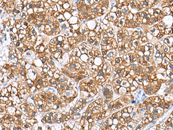 PHLDA3 Antibody - Immunohistochemistry of paraffin-embedded Human liver cancer tissue  using PHLDA3 Polyclonal Antibody at dilution of 1:110(×200)