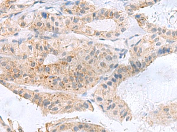 PHLDA3 Antibody - Immunohistochemistry of paraffin-embedded Human thyroid cancer tissue  using PHLDA3 Polyclonal Antibody at dilution of 1:110(×200)