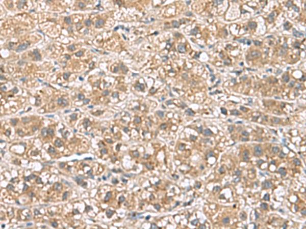 PHLDA3 Antibody - Immunohistochemistry of paraffin-embedded Human liver cancer tissue  using PHLDA3 Polyclonal Antibody at dilution of 1:110(×200)