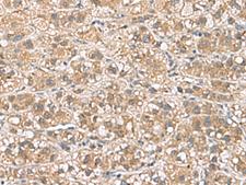 PHLDA3 Antibody - Immunohistochemistry of paraffin-embedded Human liver cancer tissue  using PHLDA3 Polyclonal Antibody at dilution of 1:110(×200)