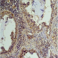 Phosphoserine Antibody - Immunohistochemical analysis of Phosphotyrosine staining in human lung cancer formalin fixed paraffin embedded tissue section. The section was pre-treated using heat mediated antigen retrieval with sodium citrate buffer (pH 6.0). The section was then incubated with the antibody at room temperature and detected using an HRP conjugated compact polymer system. DAB was used as the chromogen. The section was then counterstained with hematoxylin and mounted with DPX.