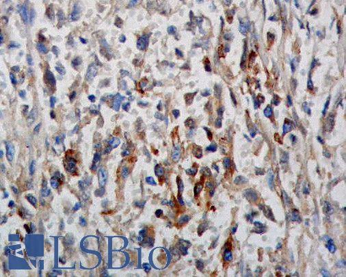 Phosphotyrosine Antibody - IHC analysis of human breast cancer tissue with anti-phosphotyrosine, Phosphotyrosine antibody.