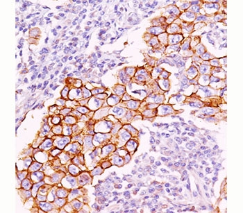 Phosphotyrosine Antibody - Phosphotyrosine antibody PY20 immunohistochemistry breast carcinoma This image was taken for the unmodified form of this product. Other forms have not been tested.