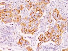 Phosphotyrosine Antibody - Formalin-fixed, paraffin-embedded human breast carcinoma stained with Phosphotyrosine antibody (PY793). This image was taken for the unmodified form of this product. Other forms have not been tested.
