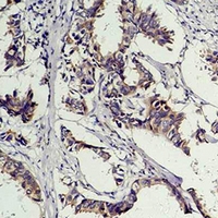 Phosphotyrosine Antibody - Immunohistochemical analysis of Phosphotyrosine staining in human breast cancer formalin fixed paraffin embedded tissue section. The section was pre-treated using heat mediated antigen retrieval with sodium citrate buffer (pH 6.0). The section was then incubated with the antibody at room temperature and detected using an HRP conjugated compact polymer system. DAB was used as the chromogen. The section was then counterstained with hematoxylin and mounted with DPX.