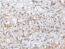 PHPT1 Antibody - Immunohistochemistry of paraffin-embedded Human liver cancer tissue  using PHPT1 Polyclonal Antibody at dilution of 1:210(×200)