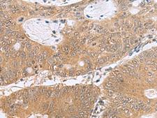 PHPT1 Antibody - Immunohistochemistry of paraffin-embedded Human colorectal cancer tissue  using PHPT1 Polyclonal Antibody at dilution of 1:170(×200)