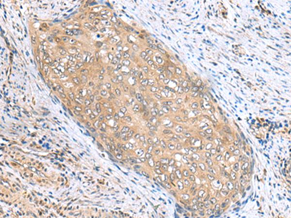 PHPT1 Antibody - Immunohistochemistry of paraffin-embedded Human cervical cancer tissue  using PHPT1 Polyclonal Antibody at dilution of 1:170(×200)