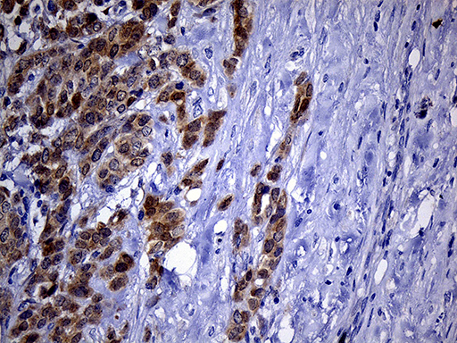 PHYHD1 Antibody - Immunohistochemical staining of paraffin-embedded Adenocarcinoma of Human breast tissue tissue using anti-PHYHD1 mouse monoclonal antibody. (Heat-induced epitope retrieval by 1mM EDTA in 10mM Tris buffer. (pH8.5) at 120°C for 3 min. (1:500)