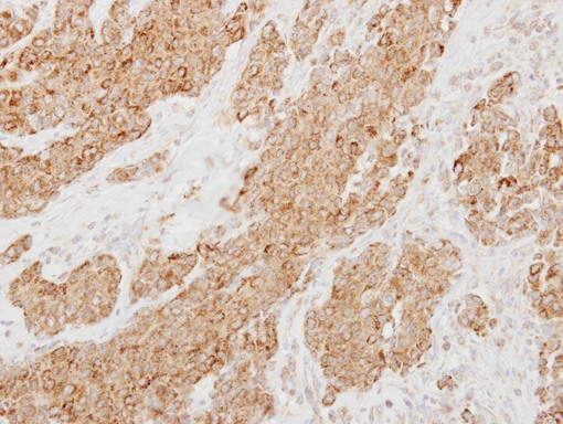 PI15 Antibody - IHC of paraffin-embedded Breast ca using Protease Inhibitor 15 antibody at 1:250 dilution.