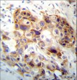 PI15 Antibody - PI15 Antibody immunohistochemistry of formalin-fixed and paraffin-embedded human breast carcinoma followed by peroxidase-conjugated secondary antibody and DAB staining.