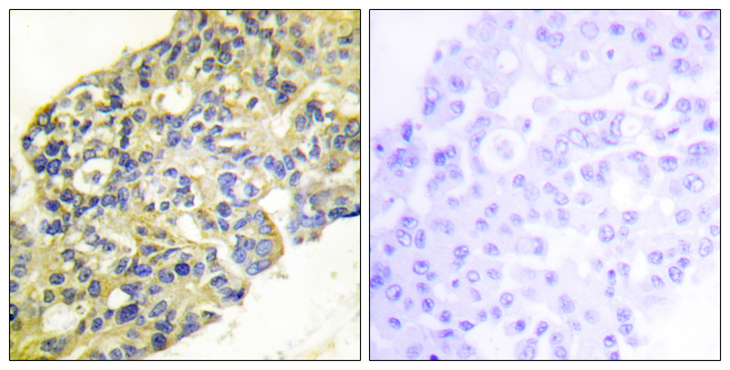 PI3K Alpha+Gamma Antibody - Immunohistochemistry analysis of paraffin-embedded human breast carcinoma tissue, using PI3-kinase p85-alpha/gamma Antibody. The picture on the right is blocked with the synthesized peptide.