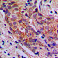 PI3K Alpha+Gamma Antibody - Immunohistochemical analysis of PI3K p85 alpha/p55 gamma staining in human breast cancer formalin fixed paraffin embedded tissue section. The section was pre-treated using heat mediated antigen retrieval with sodium citrate buffer (pH 6.0). The section was then incubated with the antibody at room temperature and detected using an HRP conjugated compact polymer system. DAB was used as the chromogen. The section was then counterstained with hematoxylin and mounted with DPX.