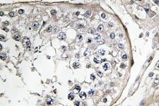 PI3K Alpha+Gamma Antibody - IHC of PI 3-kinase p85/ (Y463) pAb in paraffin-embedded human breast carcinoma tissue.