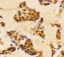 PI3K Alpha+Gamma Antibody - IHC of PI3-kinase p85-/(Tyr467/199)pAb in paraffin-embedded human breast carcinoma tissue.