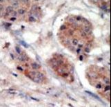 PI4K2A / PI4KII Antibody - Formalin-fixed and paraffin-embedded human cancer tissue reacted with the primary antibody, which was peroxidase-conjugated to the secondary antibody, followed by DAB staining. This data demonstrates the use of this antibody for immunohistochemistry; clinical relevance has not been evaluated. BC = breast carcinoma; HC = hepatocarcinoma.