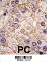 PI4K2B Antibody - Formalin-fixed and paraffin-embedded human prostate carcinoma tissue reacted with PI4K II beta antibody , which was peroxidase-conjugated to the secondary antibody, followed by DAB staining. This data demonstrates the use of this antibody for immunohistochemistry; clinical relevance has not been evaluated.