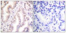 PIAS1 Antibody - Immunohistochemistry analysis of paraffin-embedded human lung carcinoma tissue, using PIAS1 Antibody. The picture on the right is blocked with the synthesized peptide.