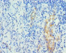 PIAS1 Antibody - Immunohistochemistry of paraffin-embedded human lung cancer using antibody at 1:100 dilution.