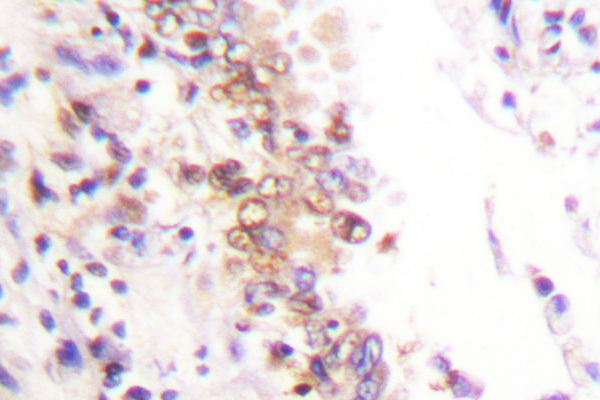 PIAS1 Antibody - IHC of PIAS1 (G24) pAb in paraffin-embedded human lung carcinoma tissue.