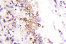 PIAS1 Antibody - IHC of PIAS1 (G24) pAb in paraffin-embedded human lung carcinoma tissue.