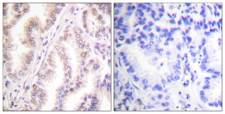 PIAS1 Antibody - Peptide - + Immunohistochemistry analysis of paraffin-embedded human lung carcinoma tissue using PIAS1 antibody.