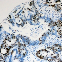 PIAS1 Antibody - Immunohistochemical analysis of PIAS1 staining in human colon cancer formalin fixed paraffin embedded tissue section. The section was pre-treated using heat mediated antigen retrieval with sodium citrate buffer (pH 6.0). The section was then incubated with the antibody at room temperature and detected using an HRP polymer system. DAB was used as the chromogen. The section was then counterstained with hematoxylin and mounted with DPX.