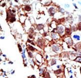 PIAS2 / PIASX Antibody - Formalin-fixed and paraffin-embedded human cancer tissue reacted with the primary antibody, which was peroxidase-conjugated to the secondary antibody, followed by AEC staining. This data demonstrates the use of this antibody for immunohistochemistry; clinical relevance has not been evaluated. BC = breast carcinoma; HC = hepatocarcinoma.